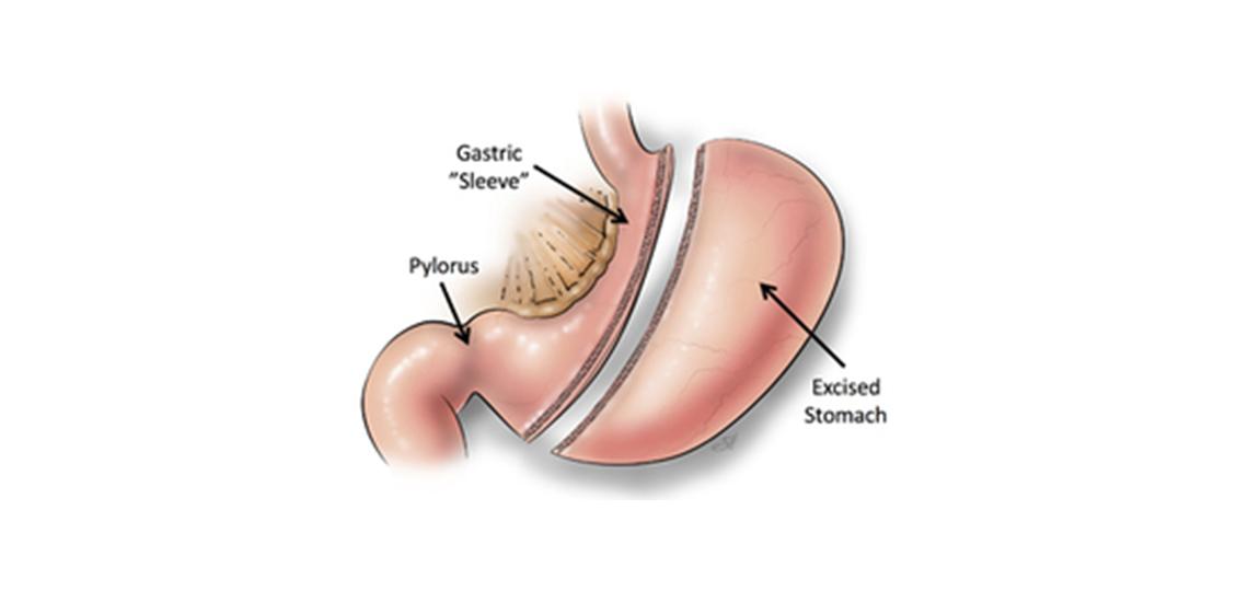 Gastric sleeve