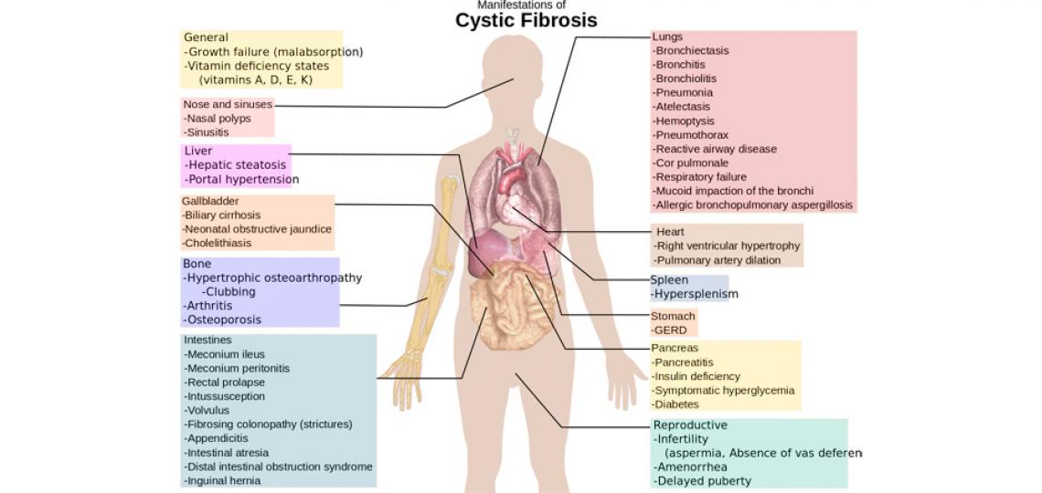 Manifestations of cystic fibrosis. Credit: wikimedia.org